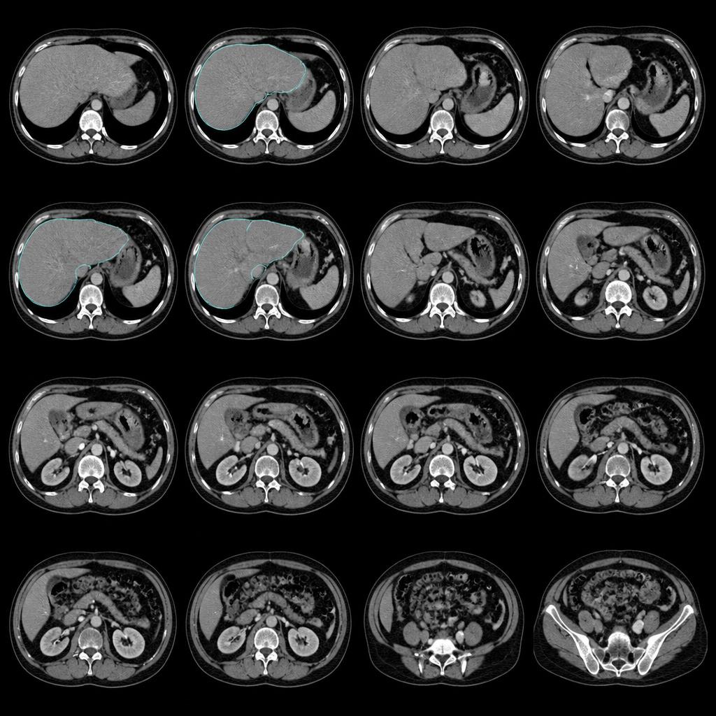 Series of axial CT slices of the abdomen