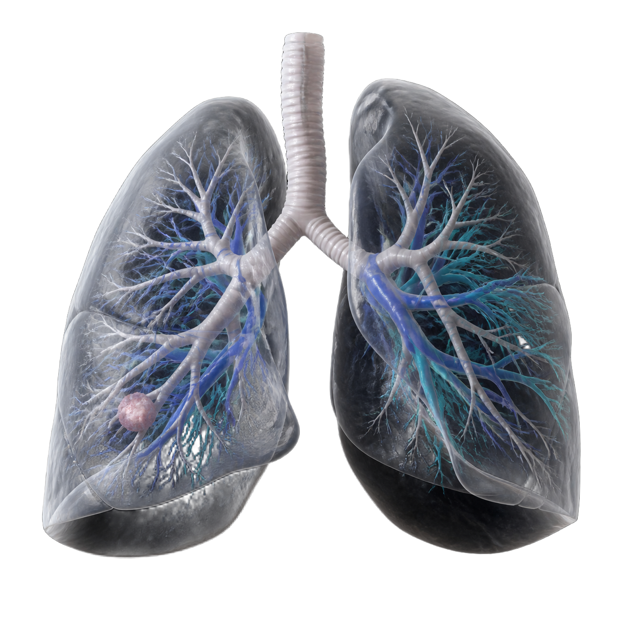 3D lung reconstruction with bronchial tree and pulmonary vessels